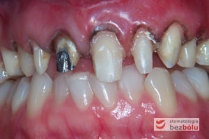 Opracowane filary protetyczne w szczęce - girlanda dziąsłowa wyrównana przy użyciu lasera wodnego