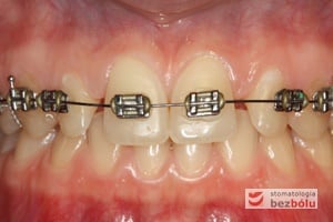 Aparat stały, faza niwelacyjna, łuk niklowo-tytanowy okrągły Aparat stały, faza niwelacyjna, łuk niklowo-tytanowy okrągły