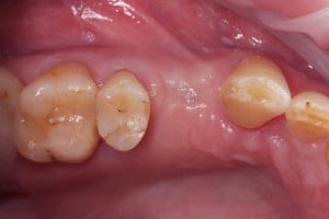 Sytuacja wewnątrzustna przed odsłonięciem implantu - widok od powierzchni okluzyjnej