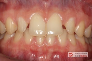 Okluzja pacjentki przed leczeniem Okluzja pacjentki przed leczeniem