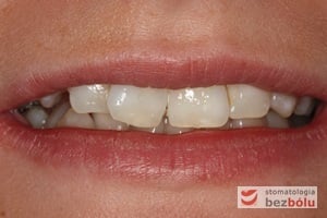 Uśmiech pacjentki przed leczeniem