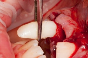 Złamany uśmiech dziecka (4 of 8)