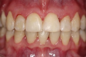 Warunki zgryzowe po leczeniu Warunki zgryzowe po leczeniu