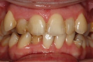 Warunki zgryzowe przed leczeniem Warunki zgryzowe przed leczeniem