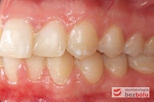 Warunki okluzyjne po leczeniu po stronie lewej