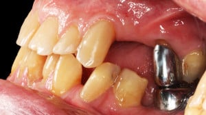 Stan wyjściowy – widok z boku.