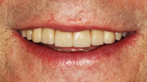 Efekt ostateczny pracy protetycznej - uśmiech pacjenta.