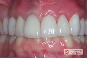 Ostateczny efekt terapeutyczny - widoczna poprawa efektu estetycznego przy jednoczesnym kamuflażu wad zębów