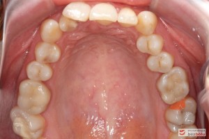 Wygląd łuku górnego przed leczeniem Wygląd łuku górnego przed leczeniem