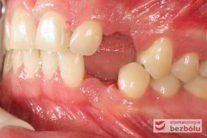 Uzębienie pacjenta - strona lewa - w takim razie przydałaby się też prawa