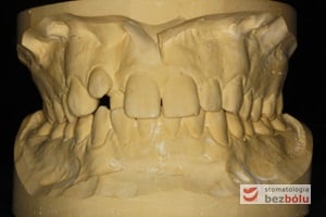 modele gipsowe przed leczeniem