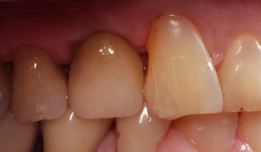 Sytuacja wewnątrzustna po zakńczonym leczeniu