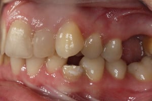 Warunki zgryzowe przed leczeniem - strona lewa Warunki zgryzowe przed leczeniem - strona lewa