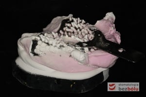 Proces odlewania gipsem wycisku alginatowego pobranego w jamie ustnej pacjenta Proces odlewania gipsem wycisku alginatowego pobranego w jamie ustnej pacjenta