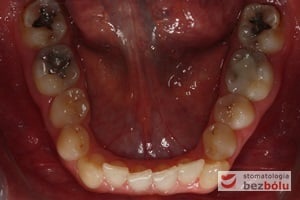 Kształt łuku dolnego przed leczeniem