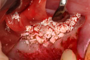 Biomateriał będący "początkiem" nowej kości upychany do wnętrza zatoki szczękowej pod membraną Schneidera Biomateriał będący "początkiem" nowej kości upychany do wnętrza zatoki szczękowej pod membraną Schneidera