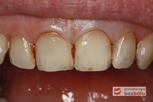 Górne siekacze centralne i boczne, jedynka górna lewa z dolegliwościami o charakterze zapalenia miazgi Górne siekacze centralne i boczne, jedynka górna lewa z dolegliwościami o charakterze zapalenia miazgi