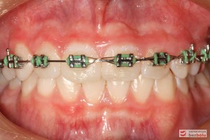 Zęby w zwarciu tuż przed demontażem aparatu Zęby w zwarciu tuż przed demontażem aparatu