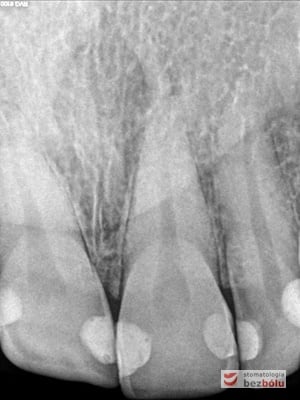 Zdjęcie RVG wykonane przed zabiegiem Zdjęcie RVG wykonane przed zabiegiem