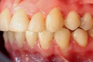 Warunki zgryzowe po leczeniu - strona lewa Warunki zgryzowe po leczeniu - strona lewa