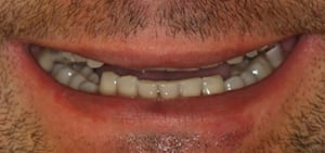 Uśmiech pacjenta przed leczeniem Uśmiech pacjenta przed leczeniem - DSD - Digital Smile Design