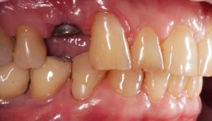 Śruba gojąca przykręcona do implantu