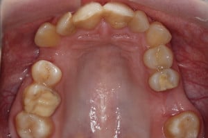 Kształt łuku górnego przed leczeniem Kształt łuku górnego przed leczeniem