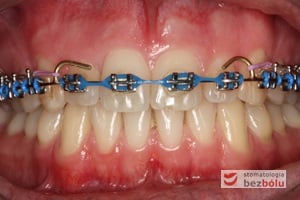 Wykończenie ortodontyczne - finishing
