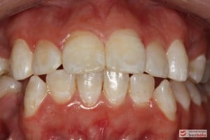 Warunki zgryzowe przed leczeniem (dokonano już ekstrakcji dolnej czwórki) Warunki zgryzowe przed leczeniem (dokonano już ekstrakcji dolnej czwórki)