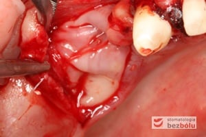 Proces szycia rany w celu stabilizacji błony fibrynowej