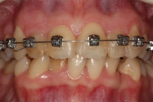 Aparat Damon zamontowany w łuku górnym Aparat Damon zamontowany w łuku górnym