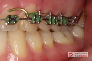 Pojawiające się luki w trakcie leczenia są domykane w technice ślizgowej