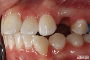 Warunki zgryzowe - strona lewa (widoczna dokonana ekstrakcja górnej czwórki) Warunki zgryzowe - strona lewa (widoczna dokonana ekstrakcja górnej czwórki)