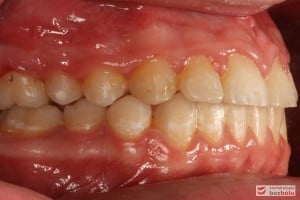 Warunki zgryzowe po leczeniu, strona prawa Warunki zgryzowe po leczeniu, strona prawa