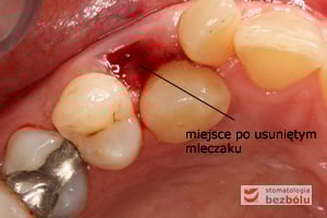Fragment łuku górnego - widok okluzyjny - kieł ustawiony dopodniebiennie, dwójka dowargowo Fragment łuku górnego - widok okluzyjny - kieł ustawiony dopodniebiennie, dwójka dowargowo