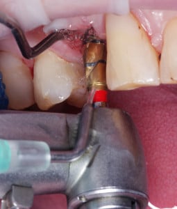 Preparacja łoża implantu