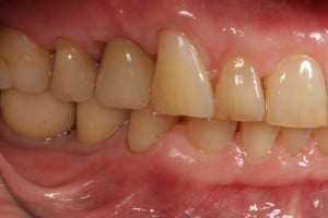 Sytuacja wewnątrzustna po zakńczonym leczeniu