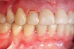 Warunki zgryzowe po leczeniu - strona prawa Warunki zgryzowe po leczeniu - strona prawa