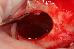 Wnętrze zatoki szczękowej widoczne po uniesieniu błony Schneidera Wnętrze zatoki szczękowej widoczne po uniesieniu błony Schneidera