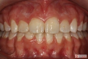 Warunki zgryzowe po leczeniu Warunki zgryzowe po leczeniu