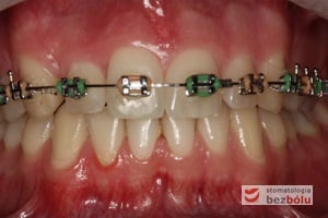 Wprowadzanie siekacza bocznego do łuku przy użyciu łuków niklowo-tytanowych