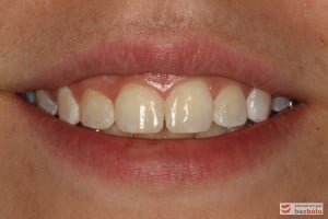 Uśmiech pacjentki po leczeniu Uśmiech pacjentki po leczeniu