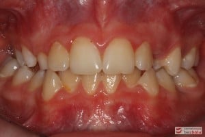 Warunki okluzyjne przed leczeniem Warunki okluzyjne przed leczeniem