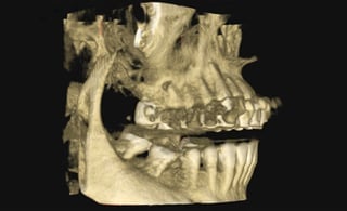 Dysfunkcje narządu żucia