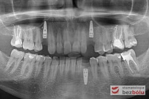 Kontrolne zdjęcie ortopantomograficzne po zabiegu chirurgicznym