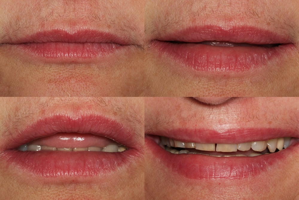 Sytuacja po zakończonym leczeniu - widok od przodu