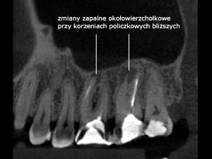 Potęga tomografii wolumetrycznej 3D