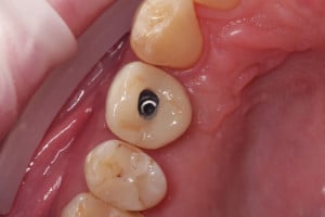 Korona pełnoceramiczna przykręcona do implantu przed zamknięciem kompozytem otworu na śrubę