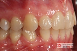 Strona prawa - zęby w zwarciu Strona prawa - zęby w zwarciu