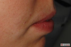 Profil pacjentki przed leczeniem - widoczna niekompetencja warg Profil pacjentki przed leczeniem - widoczna niekompetencja warg